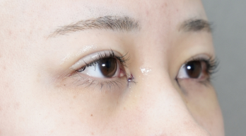 手術前の状態 その1