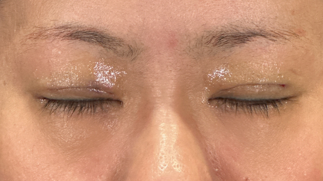 Postoperative Condition Part 1