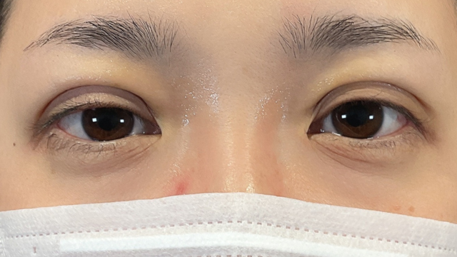 手术前的状态 其一