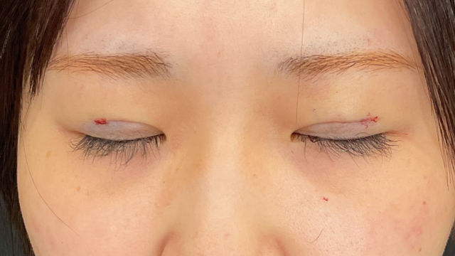 手术前的状态 其一