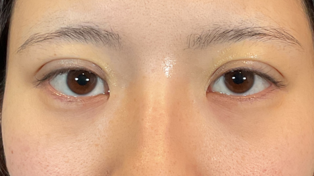 手术前的状态 其一