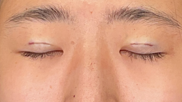 Postoperative Condition Part 1