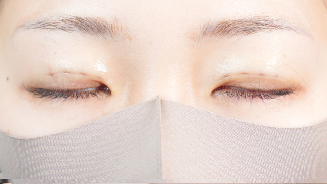 手術前の状態 その1