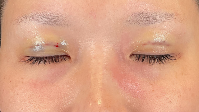 Postoperative Condition Part 1