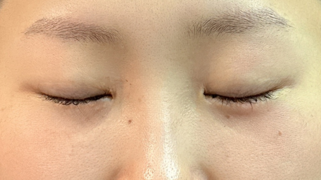 手术前的状态 其一