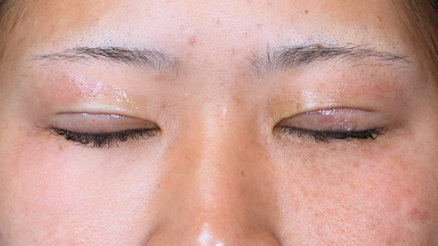 Postoperative Condition Part 1