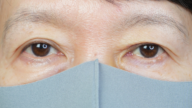 手术前的状态 其一