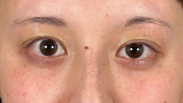 手术前的状态 其一