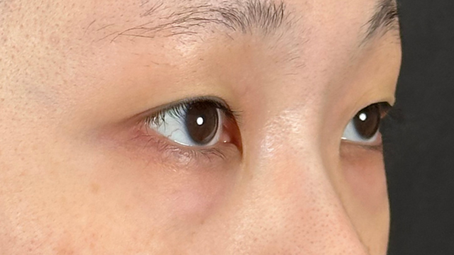 手术前的状态 其一