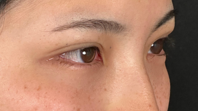 手术前的状态 其一