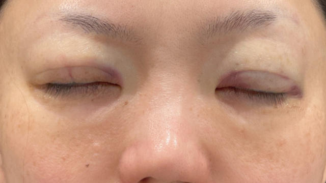 手術前の状態 その1