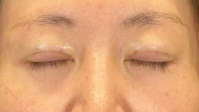 手術前の状態 その1