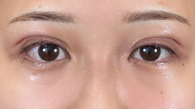 手術前の状態 その1