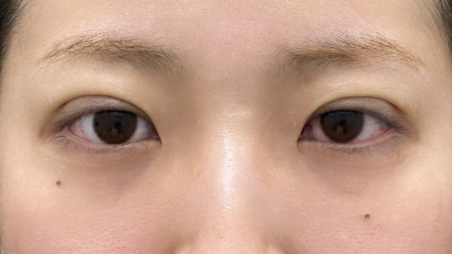 手术前的状态 其一