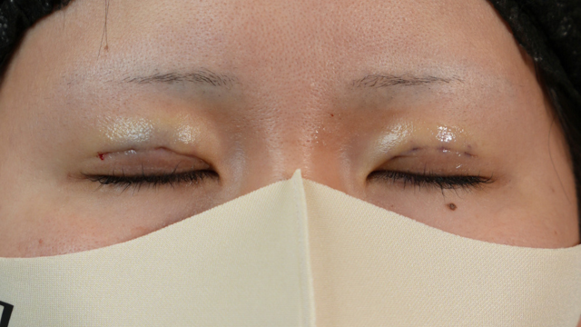 Postoperative Condition Part 1