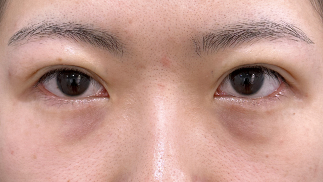 手術前の状態 その1