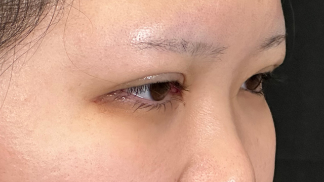 手术前的状态 其一