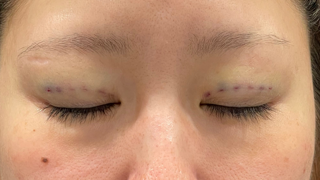 Postoperative Condition Part 1