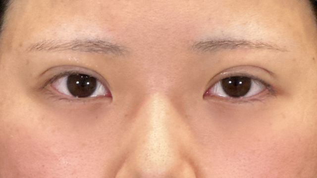 手術前の状態 その1