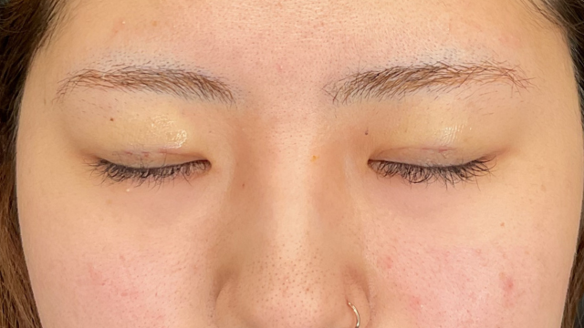 手術前の状態 その1