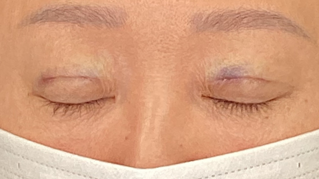 手術前の状態 その1