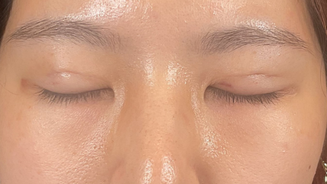 手術前の状態 その1