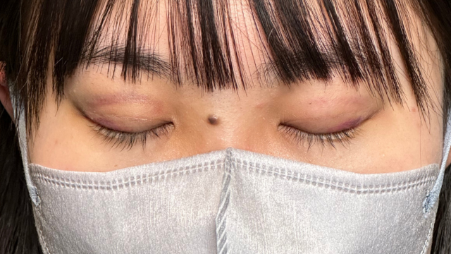 手术前的状态 其一