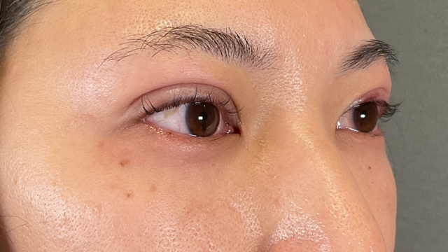 手術前の状態 その1