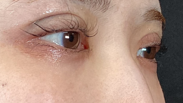 手術前の状態 その1