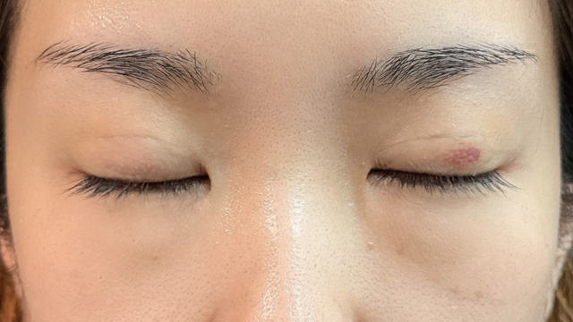 手术前的状态 其一