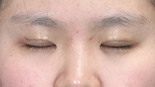 手术前的状态 其一