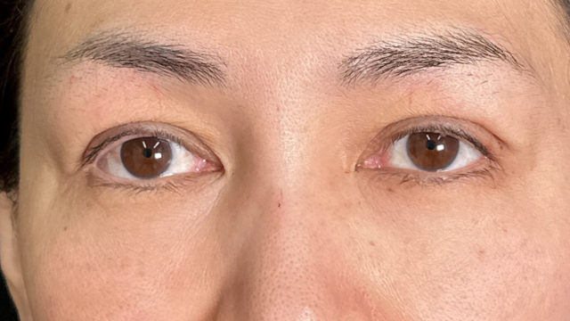 手术前的状态 其一