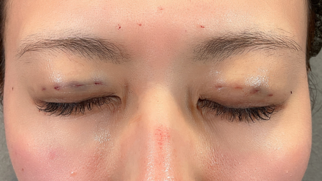 手术前的状态 其一