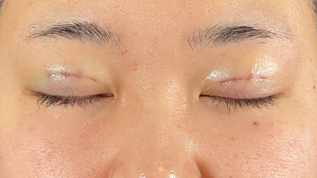 手术前的状态 其一