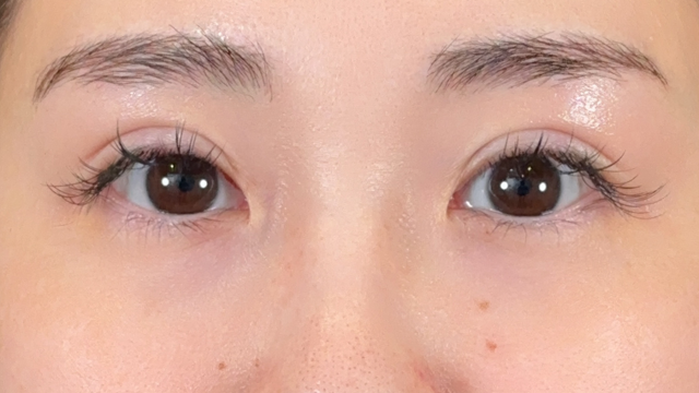 手術前の状態 その1