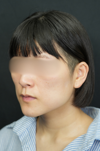 手術前の状態 その1