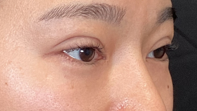 手術前の状態 その1