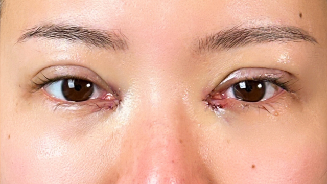 手術前の状態 その1