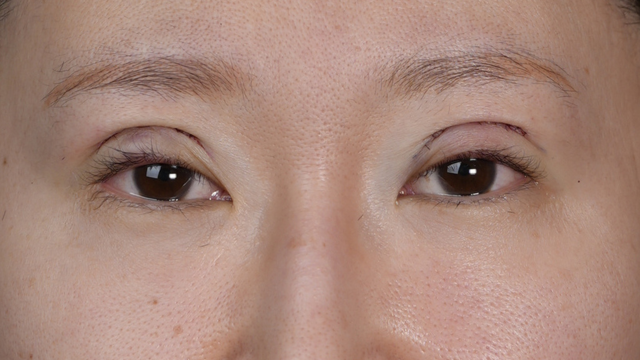 手术前的状态 其一