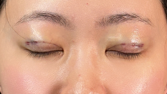 手術前の状態 その1