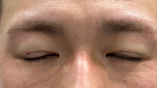 手術前の状態 その1