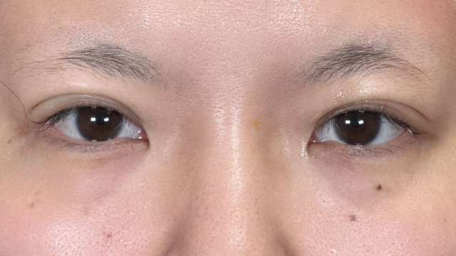 手术前的状态 其一