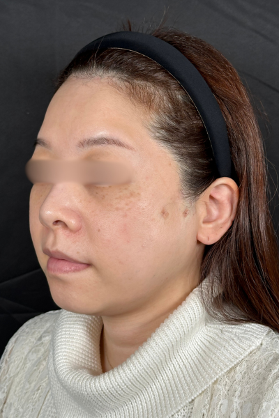 手術前の状態 その1