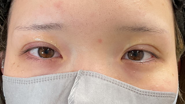 手術前の状態 その1