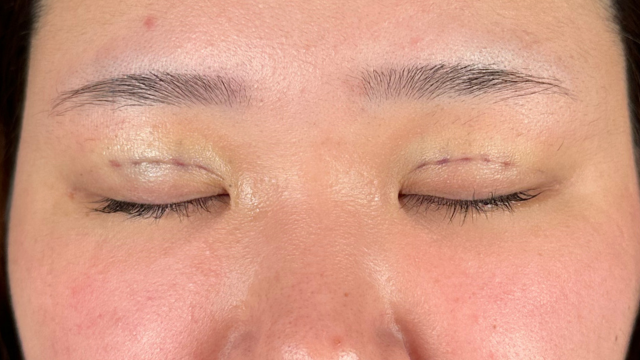 手术前的状态 其一