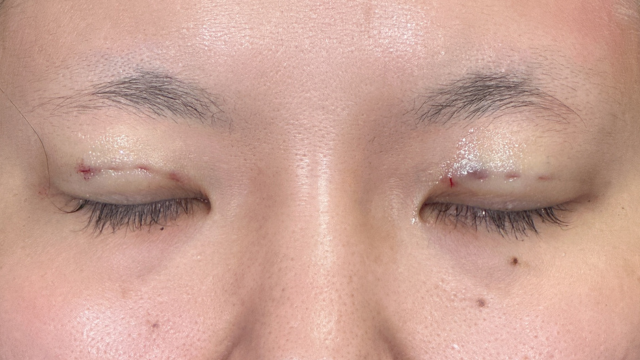 手术前的状态 其一