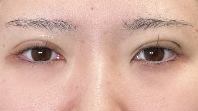 手术前的状态 其一