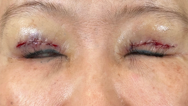 手术前的状态 其一