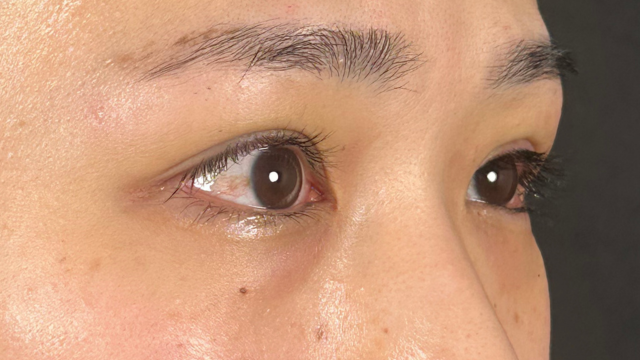 手術前の状態 その1