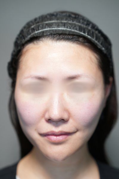 手術前の状態 その1